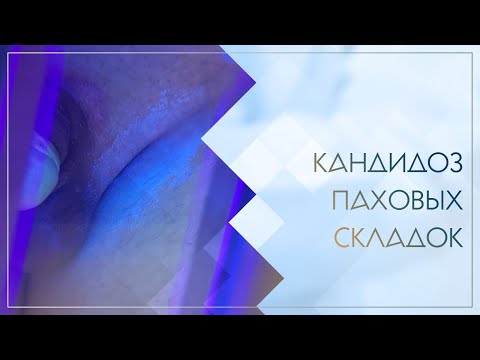 😐 Кандидоз паховых складок. Клинический случай №36