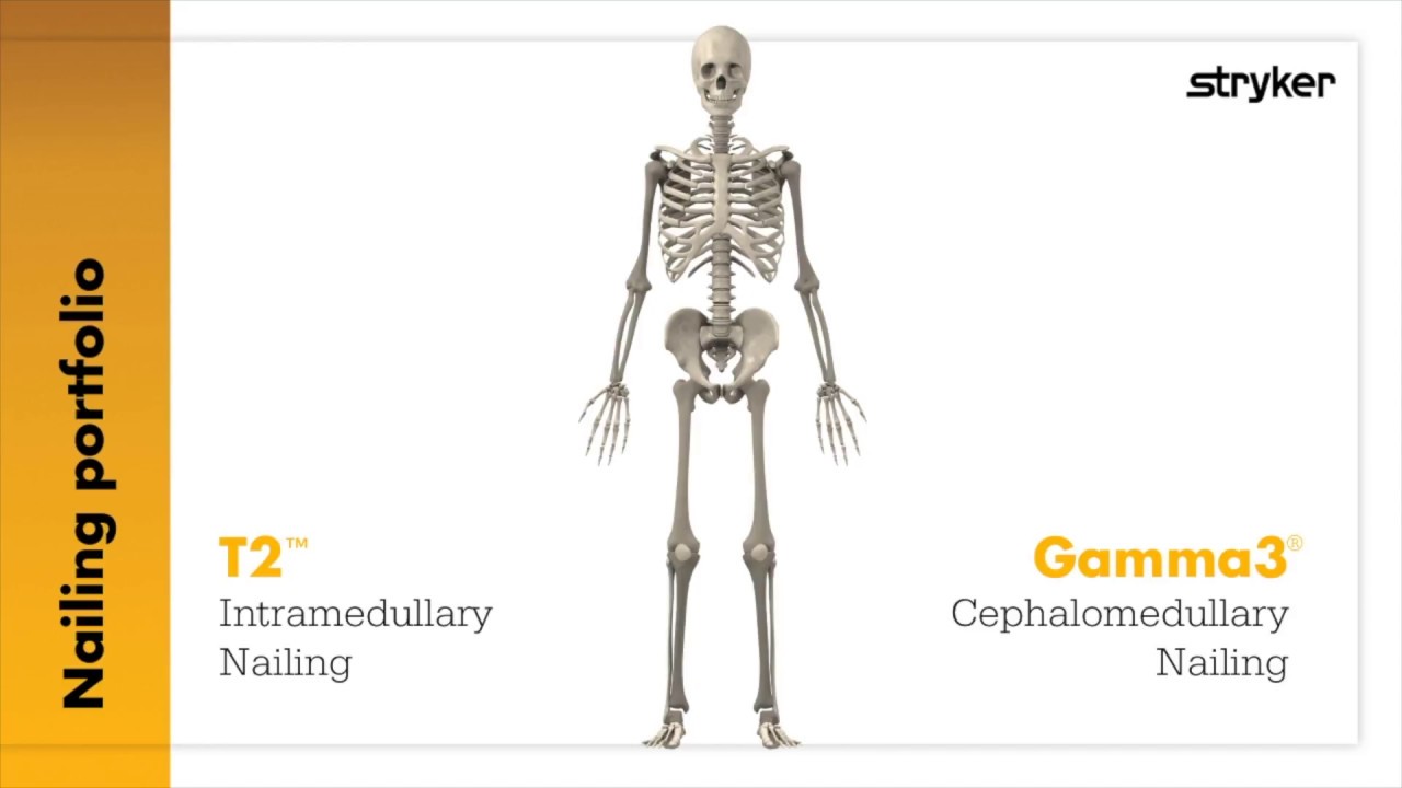 T2 & Gamma3. Innovation. Simplicity. Versatility. Gamma3 T2 Tibia T2 Recon  T2 SCN T2 Femur T2 PHN T2 Humerus T2 Ankle T2 Arthrodesis T2 Kids - PDF  Free Download