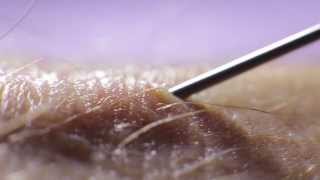 The Apprentice Doctor Venipuncture Course: Keys to Symbols Used