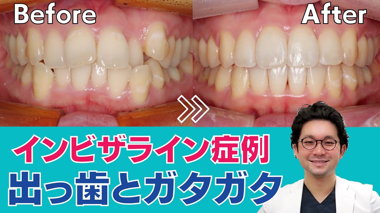 インビザライン症例2】マウスピース歯科矯正 出っ歯・ガタガタ症例