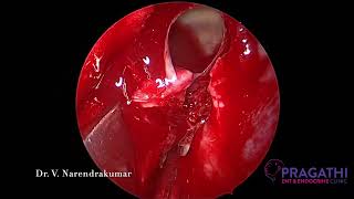 Endoscopic Transclival Approch -Dr. V. Narendrakumar