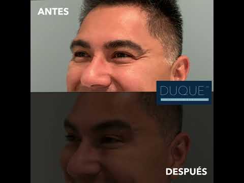 Antes y Después 13 | Dr. Jorge Duque Silva