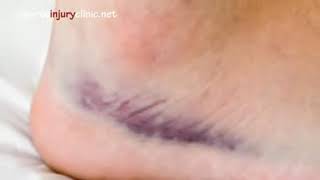 Vid02  Ankle Sprain   Explained in a 90 seconds