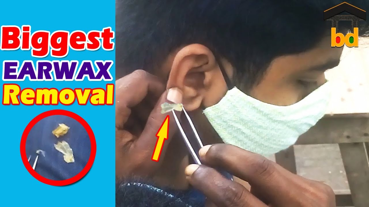 Biggest Earwax Removed for 1st Time of This Guy II Amazing Street Ear Cleaning BD YouTube