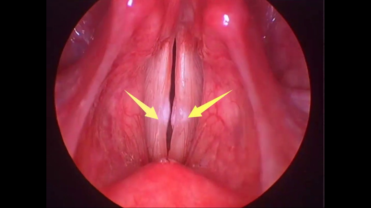 Cuerdas vocales operacion edema