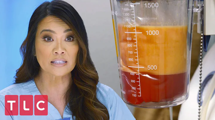Dr. Lee Drains Fat From a Woman's Arm | Dr. Pimple...