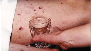 The HORRIFYING History of Meningitis
