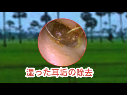 うじ耳垢,湿った耳垢の除去 - YouTube