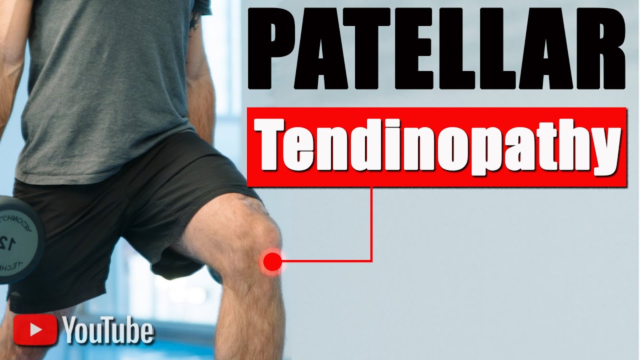 Knee (Patellar) Pain Tendinitis. Best Exercises, Strengthen, Rehab