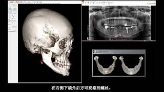 下颌重建和下巴假体手术 [H整形医院]  韩国整形医院