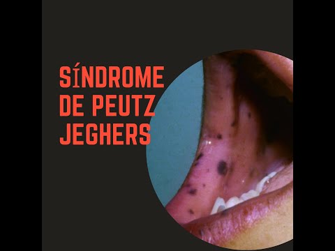 Patología bucal en pacientes pediátricos / Síndrome de Peutz-Jeghers