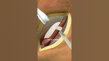 Inguinal Hernia Repair Surgery (3D Animation) #epicmusicword #3danimation #epic #facts #3dmodeling