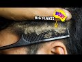 Very Big Dandruff Flakes and Dry Itchy Scalp Removal #400