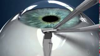 ExPRESS miniature glaucoma device