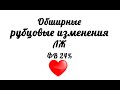 Обширные рубцовые изменения левого желудочка на эхокардиографии. ФВ 24%.