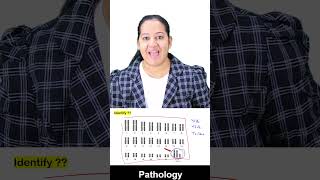1 minute learning:  Klinefelter Syndrome  47; XXY
