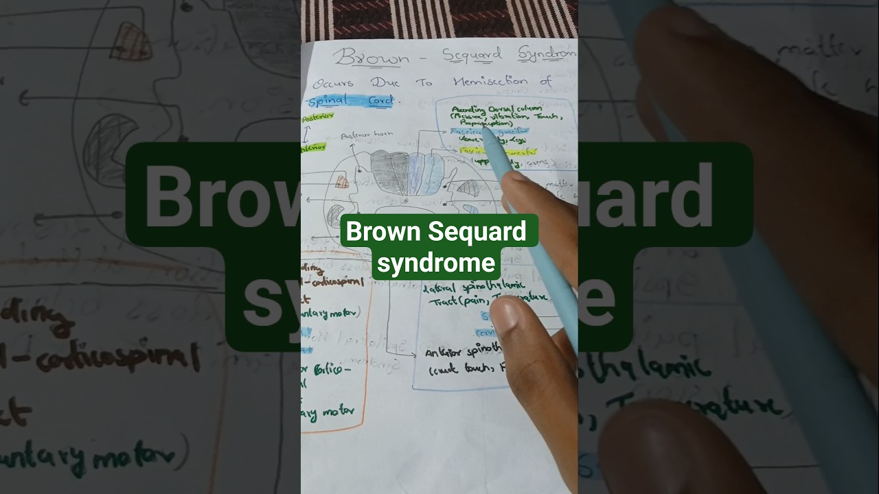 Brown-Séquard Syndrome: Hemisection of the Spinal Cord