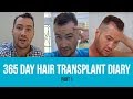 Hair transplant results - PART 1