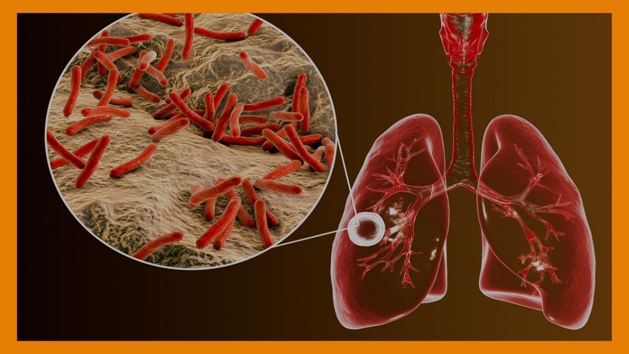 | TIBA YA TB MADUKANI | Baadhi ya maduka yaruhusiwa kupima na kutoa tiba ya kifua kikuu