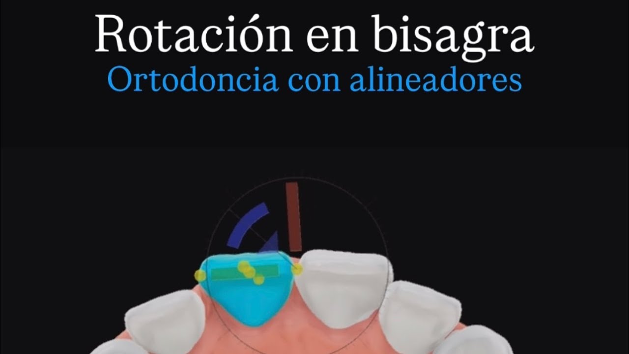 Rotación en bisagra, centros de rotación en ortodoncia con alineadores