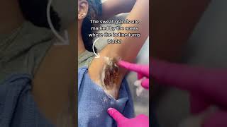 BOTOX FOR HYPERHYDROSIS! #botox #plasticsurgeon
