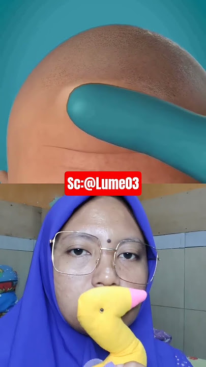 Hidung tumbuh di dahi @Lume03 #alizasehar #zarooratrishta #bkffofficial1 #animation #doctor