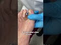 Ingrown Toenails