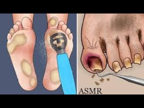 ASMR The best treatment remove calluses due to hot sand desert ...