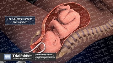 Delivery with Forceps