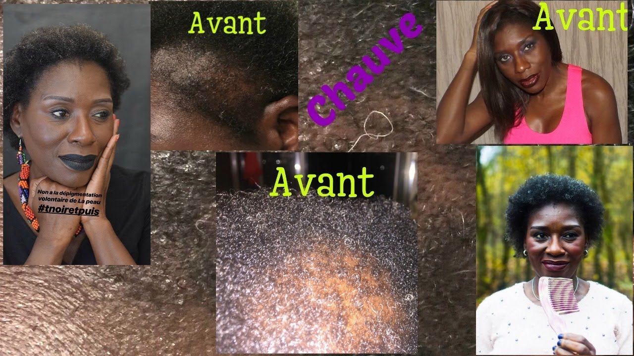 J'ai failli devenir chauve,,,,Mon histoire YouTube