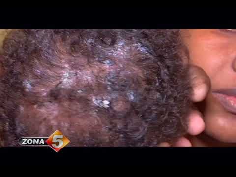 enfermedades de gusanos en la cabeza