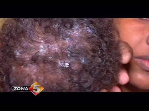 Video: Infección Por Gusanos Estomacales (fisalopterosis) En Perros