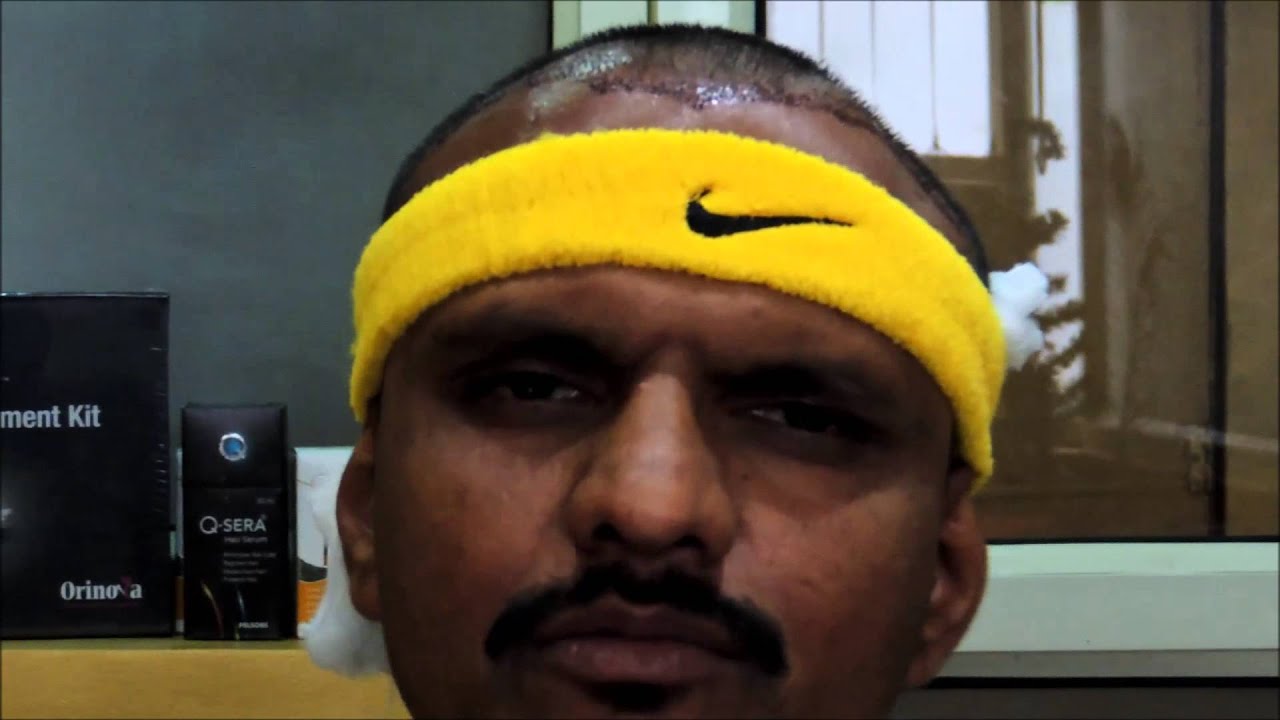 Sai Cosmetics|Patient review|Best hair transplant center Pune|Hair transplant Pune|Hair loss