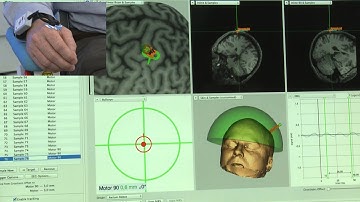 TMS Current Direction Control Over Targeted Brain Area