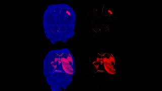 Mouse Brains Imaging using Light Sheet Microscopy and Tissue Clearing