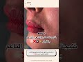 خطورة استخدام الليزر لإزالة الشعر ليزر تجميل عناية السعودية ترند تيك توك