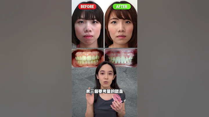 骨性暴牙能不能只做牙齿矫正#嘴凸 - 天天要闻