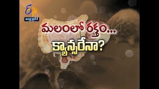 Blood in Motion- is it cancerous? | Sukhibhava | 6th June 2019 | Full Episode | ETV Andhra Pradesh