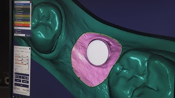 3D Printed model with Implant Analog fitting - DentaFab 3D Printer with model resin