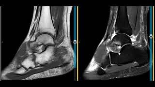 Ankle pain secondary to sinus tarsi and and spring ligament injuries