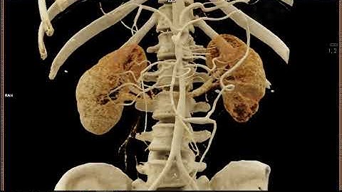 Neurofibromatosis and Stenosis with Cinematic Rendering 2