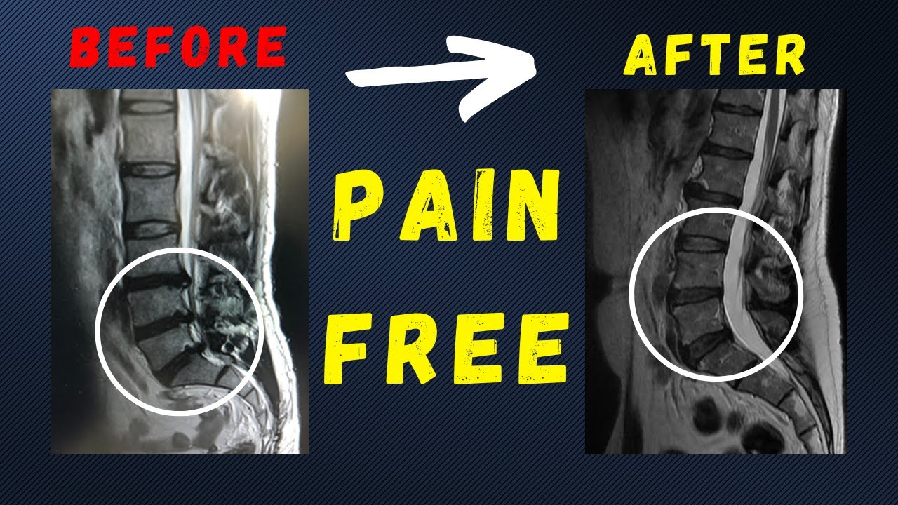 L4 L5 L5 S1 Disc Herniation Recovered Pain Free Without Surgery YouTube
