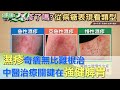 體內濕氣重！濕疹反覆發作 根治關鍵在強健脾胃 健康2.0