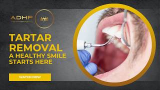 Tartar Removal: A Healthy Smile Starts Here 🦷 ADHP