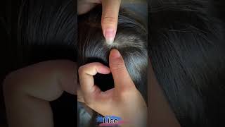 Part 19 Lice Removal Treatment Satisfying Lice Popping