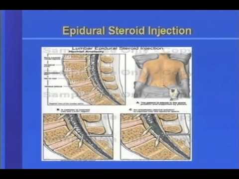 Interventional Approach to Neuropathic Pain