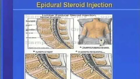 Interventional Approach to Neuropathic Pain - DayDayNews