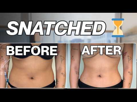 My Liposuction Journey 4 Months Post-Op | Stunning Results! thumbnail