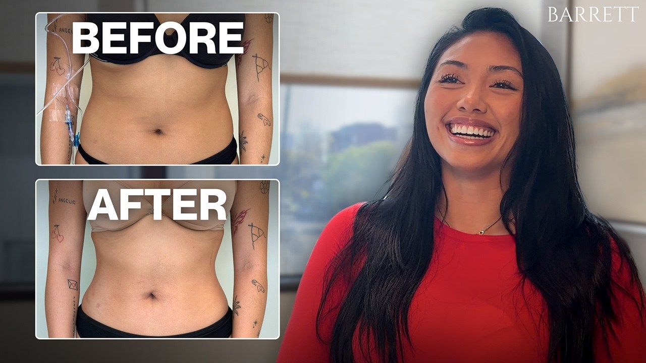 My Liposuction Journey 4 Months Post-Op | Stunning Results!