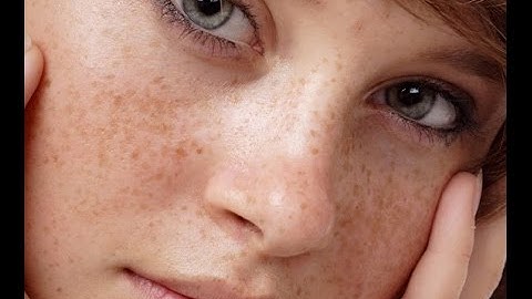 Cách Trị nám, làm đẹp da với dầu gấc